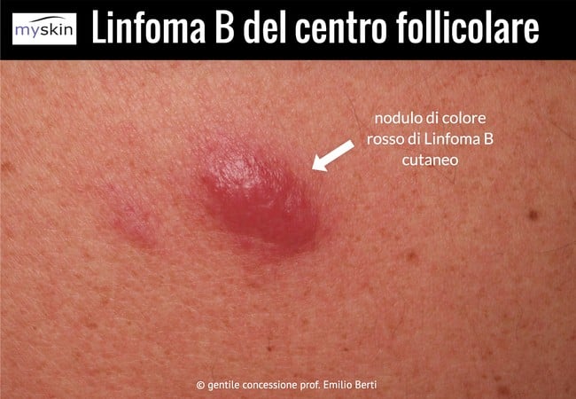Linfoma B centro follicolare