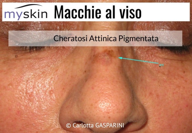 macchie_al_viso_-_cheratosi_attinica_pigmentata