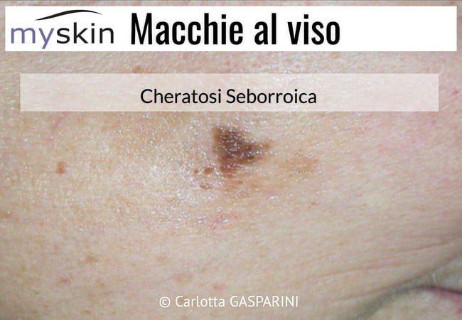 macchie_al_viso_-_cheratosi_seborroica