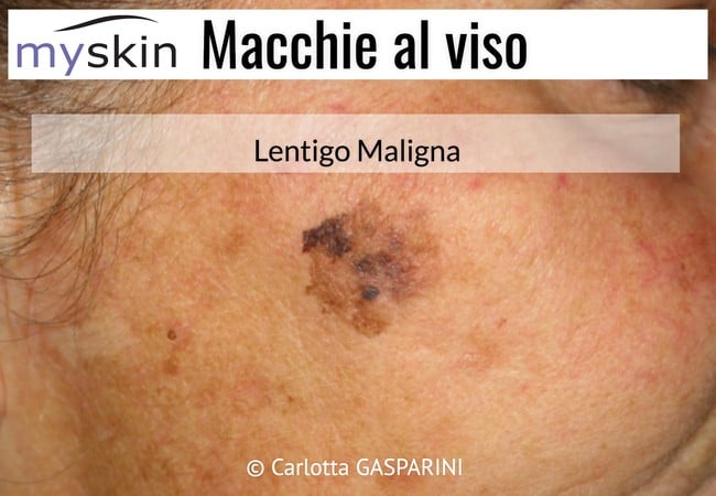 macchie_al_viso_-_lentigo_maligna