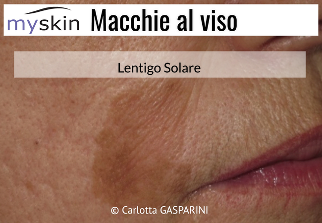 macchie_al_viso_-_lentigo_solare