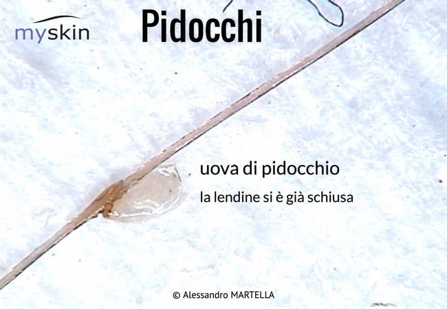 pidocchi_0