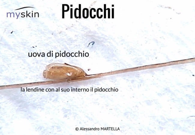 pidocchi_1