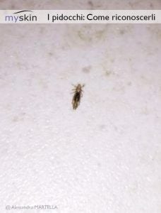 Come contrastare i pidocchi in modo naturale Pidocchi in testa: sintomi e rimedi | Myskin - Dermatologi Online