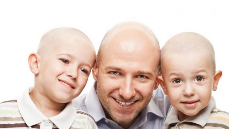 Alopecia areata (caduta dei capelli): sintomi, cause e cura