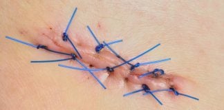 Neo sospetto era un Melanoma – intervista a Monica di APAIM melanoma_cicatrice