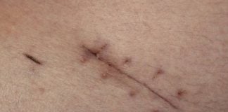 Melanoma quarto stadio: il sole dentro melanoma