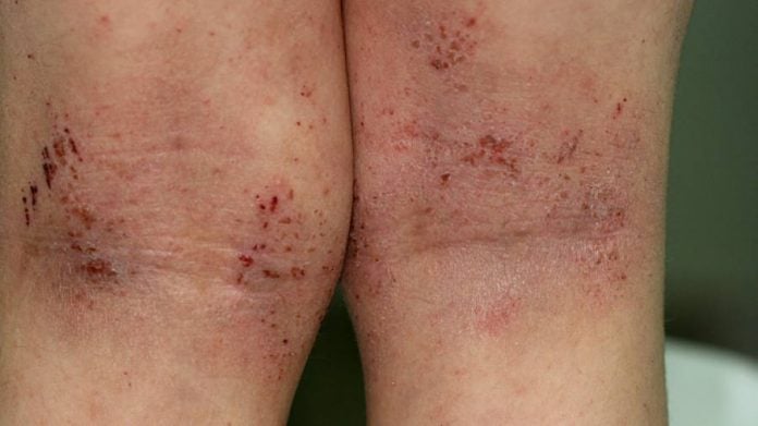 dermatite atopica dermatite atopica