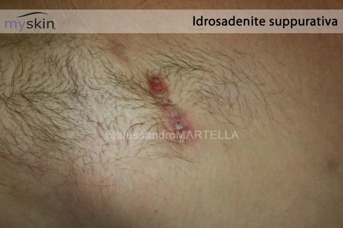 Idrosadenite suppurativa