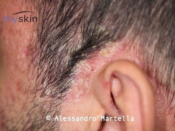 Crosta lattea del neonato : sintomi e trattamento - Myskin - Dermatologi  Online