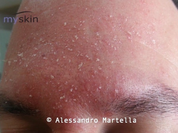 Dermatite seborroica del viso