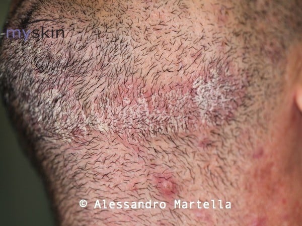 Dermatite seborroica del cuoio capelluto (corona seborroica)