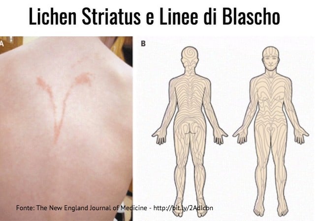 Lichen striatus e Linee di Blascho