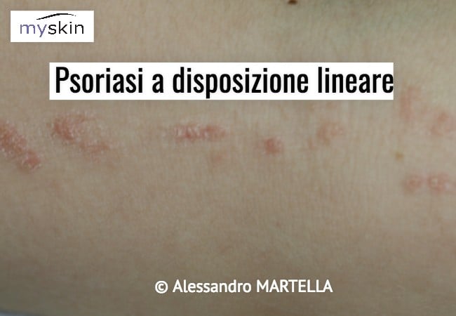 Psoriasi a disposizione lineare