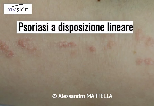 Psoriasi a disposizione lineare