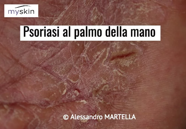 Psoriasi al palmo della mano