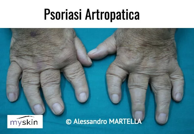 Psoriasi artropatica