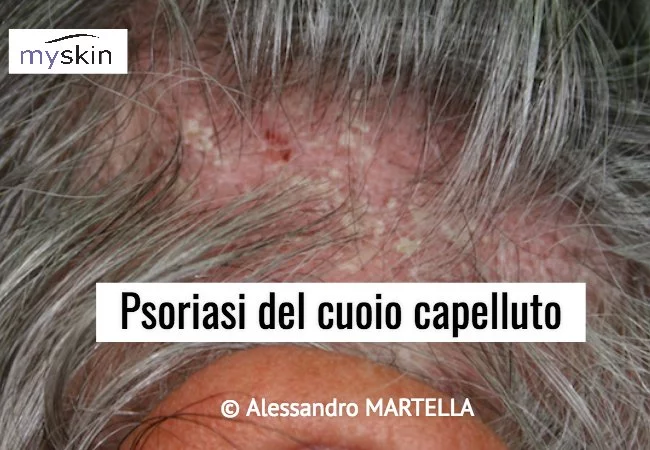 Psoriasi del cuoio capelluto