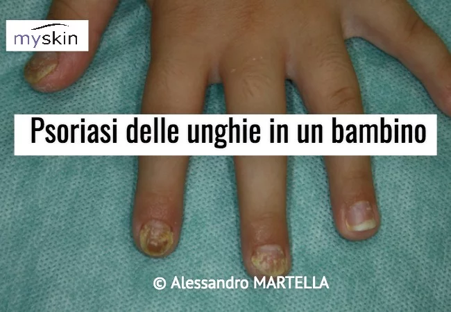 Psoriasi delle unghie nel bambino