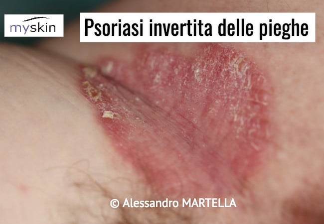 Psoriasi invertita delle pieghe