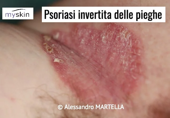 Psoriasi invertita delle pieghe