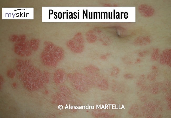 Psoriasi Nummulare