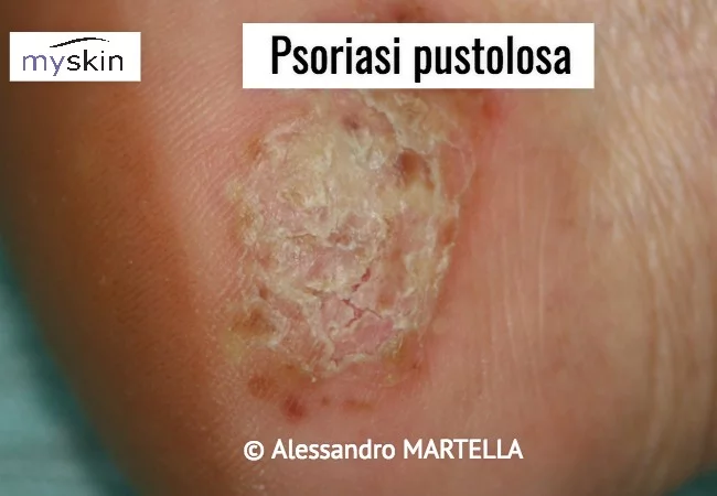 Psoriasi pustulosa plantare