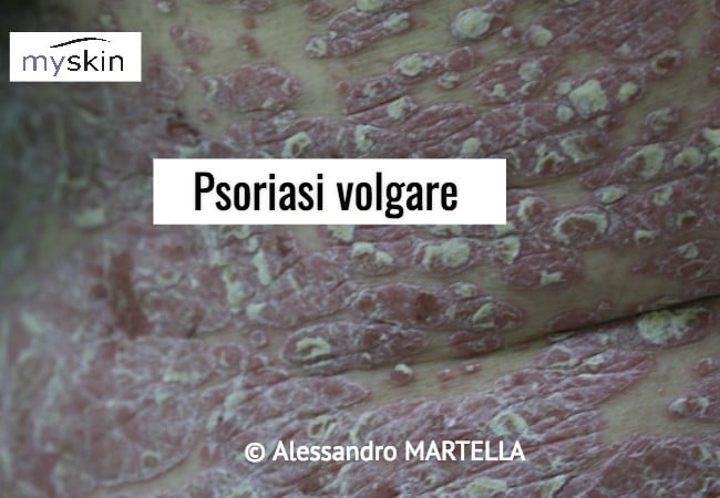 Psoriasi volgare diffusa al tronco