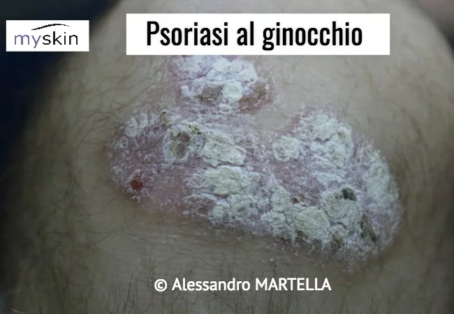 Psoriasi volgare al ginocchio