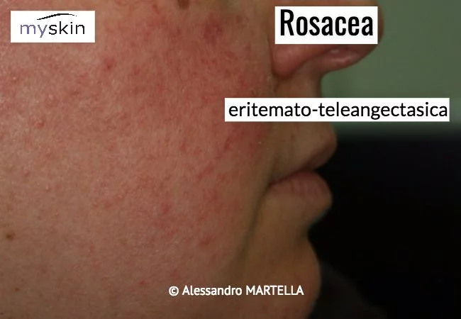 rosacea_eritemato-teleangectica