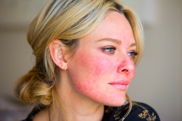 Rosacea: cause, sintomi e terapia