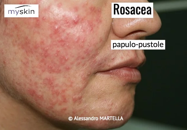 rosacea papulo pustolosa