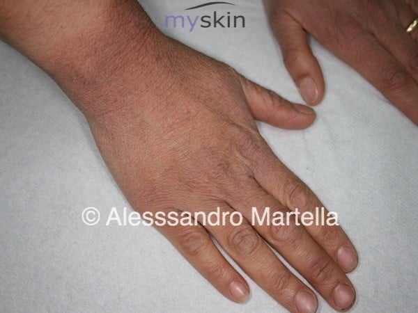 dermatite alle mani come curarla