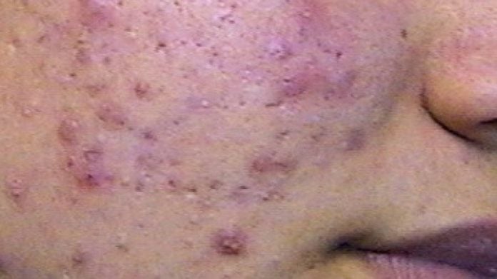 acne viso cura acne viso cura