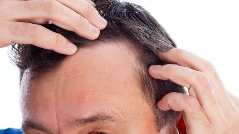 Caduta dei capelli: si può evitare? Cause, diagnosi e rimedi
