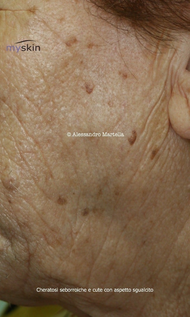 cheratosi seborroica