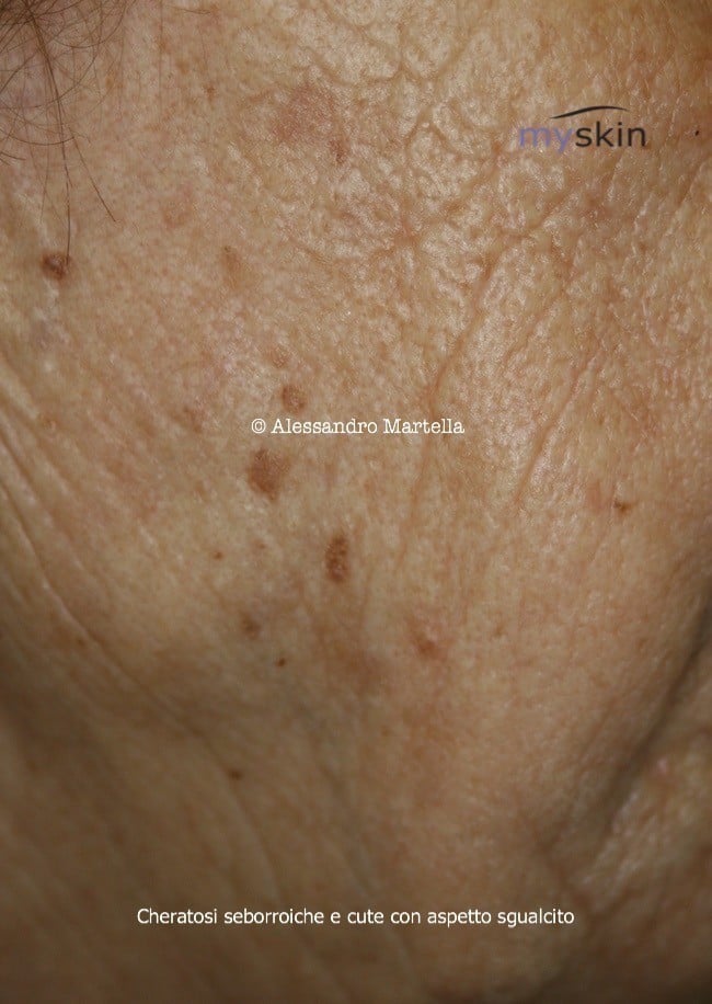 cheratosi seborroica