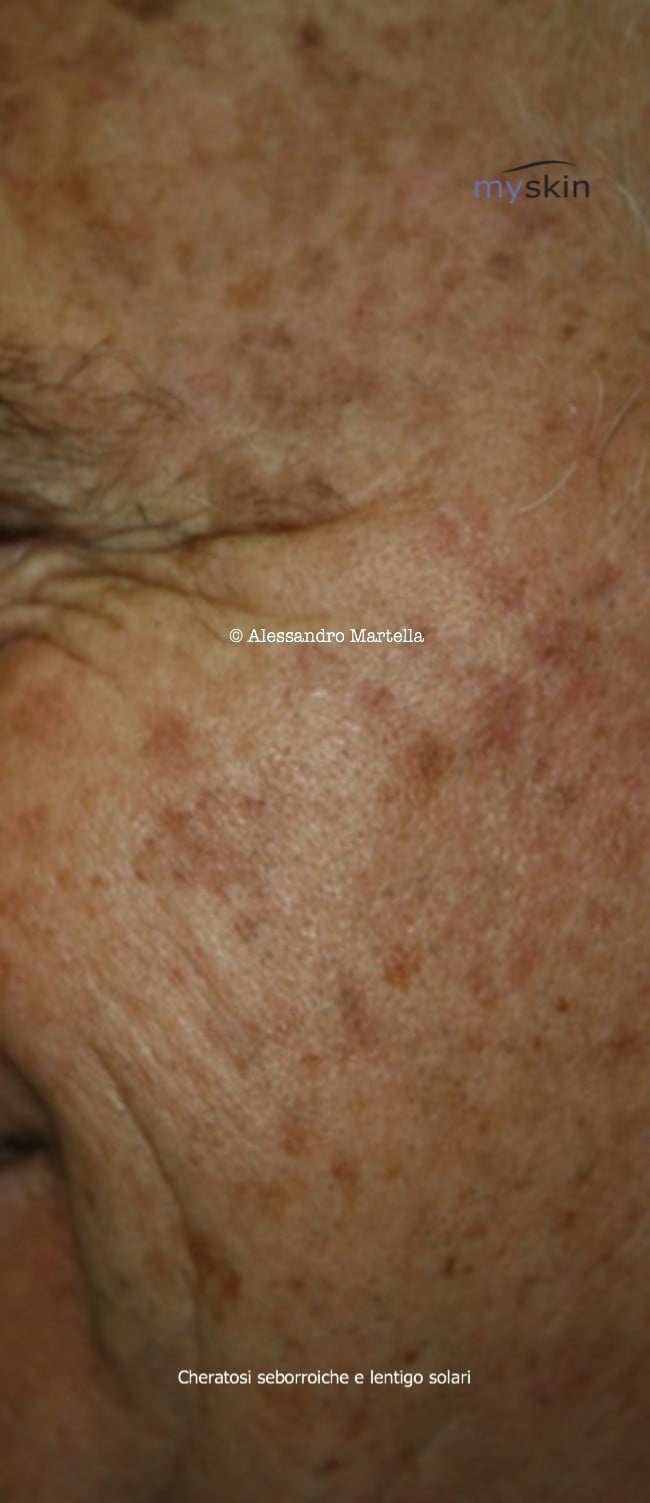 cheratosi seborroica lentigo solare