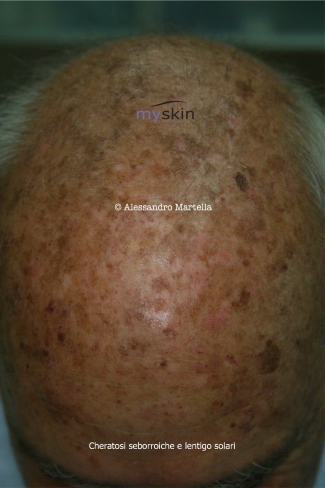 cheratosi seborroica lentigo solare