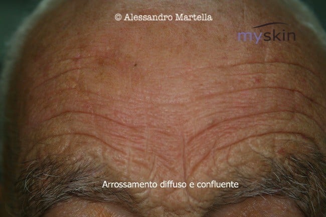 arrossamento diffuso e confluente