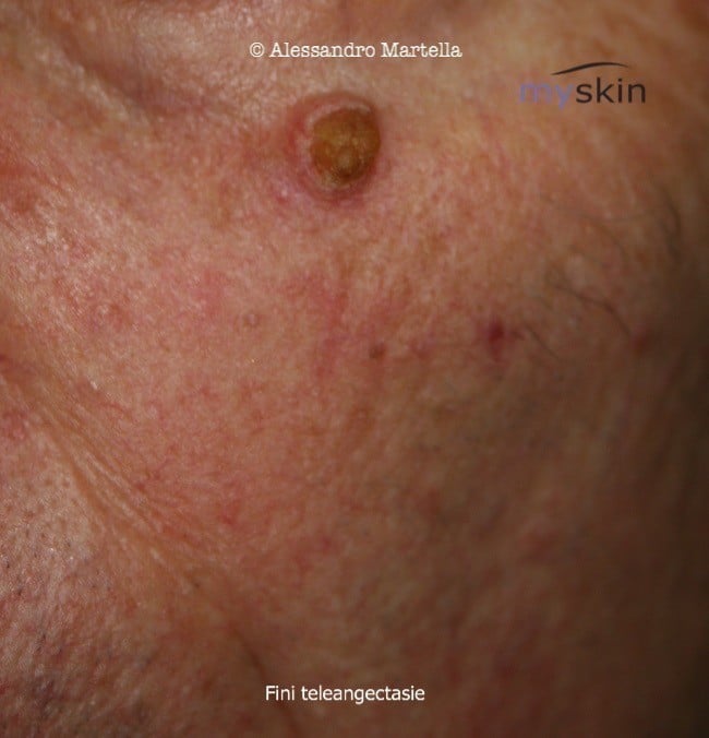 teleangectasie