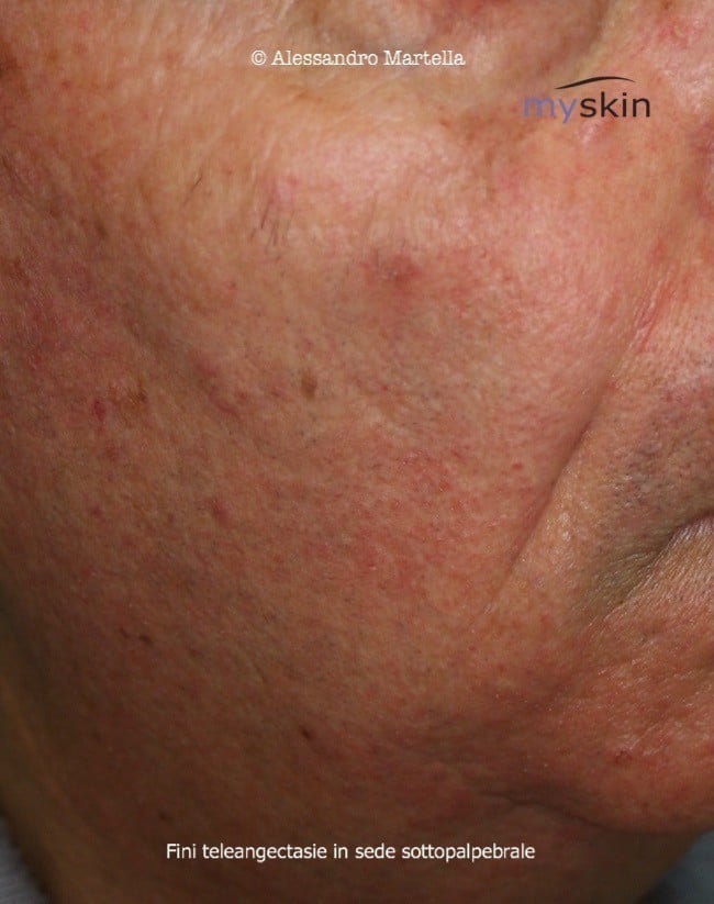 teleangectasie