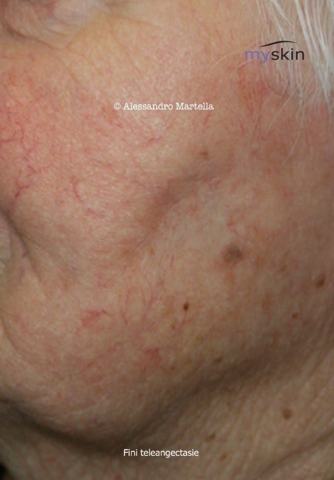 teleangectasie
