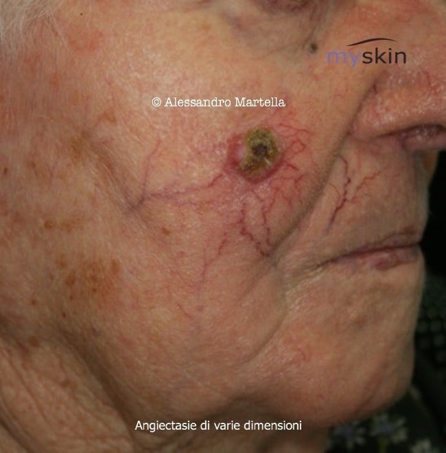 teleangectasie