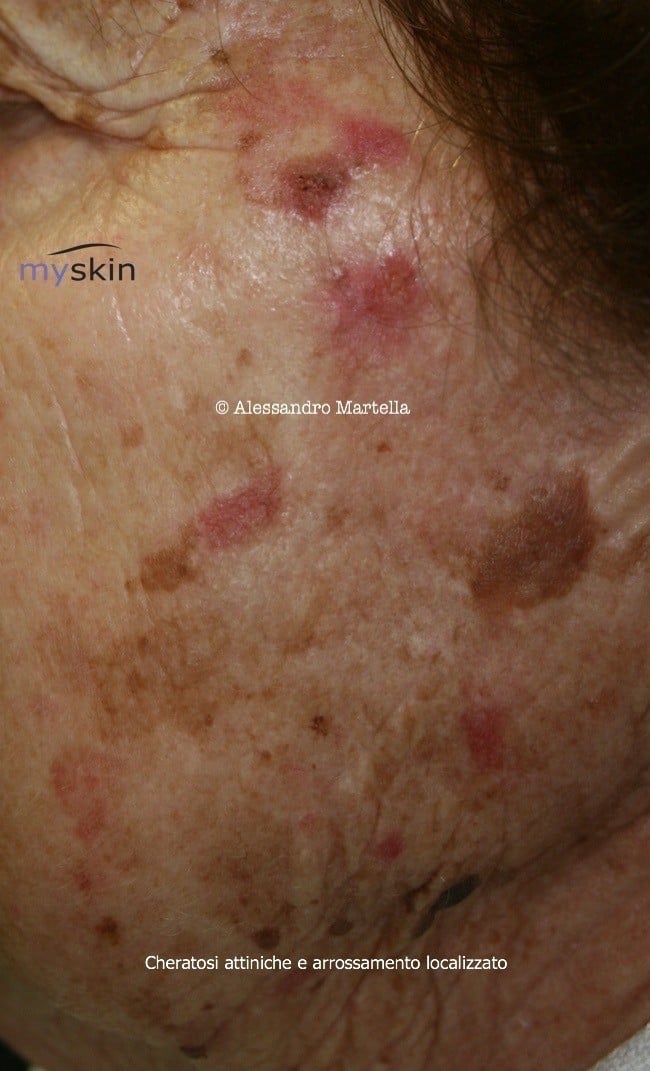 cheratosi attinica