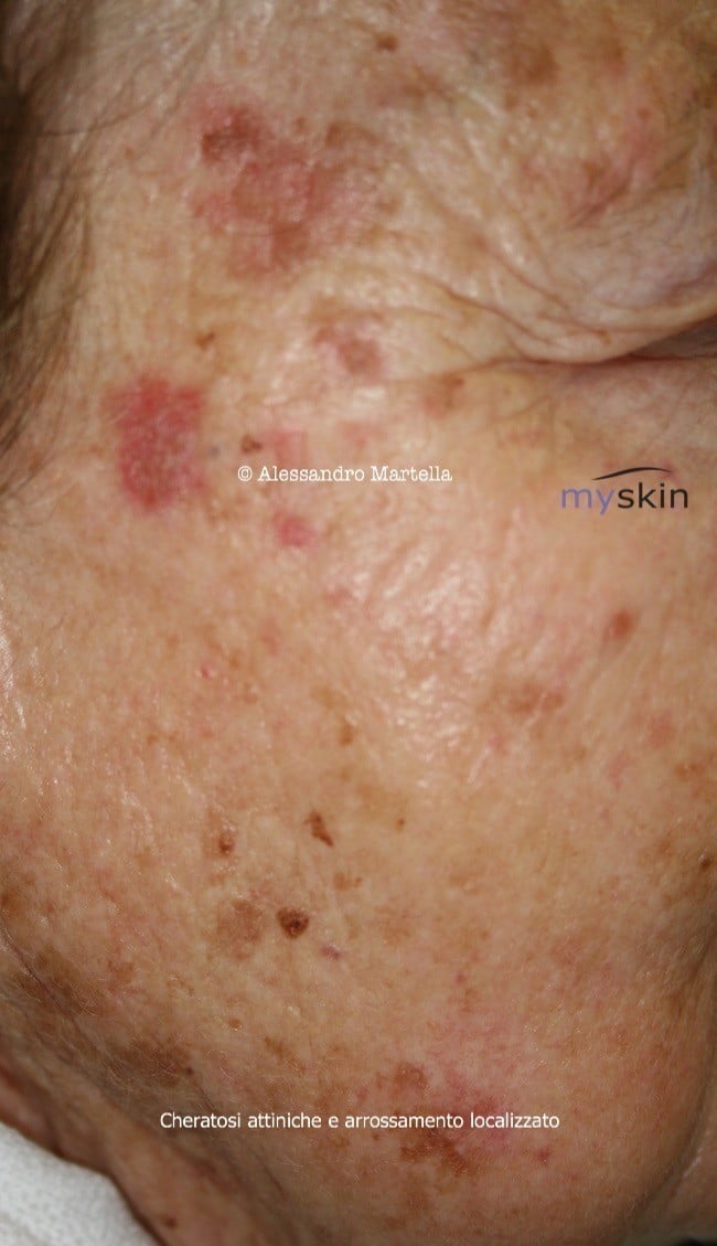 cheratosi attinica