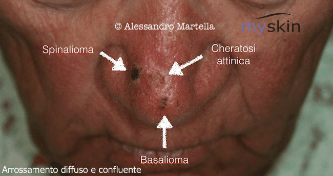 arrossamento diffuso e confluente