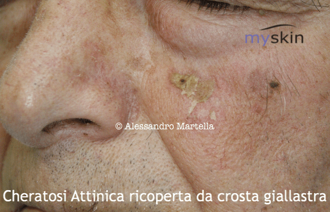 Cheratosi attinica