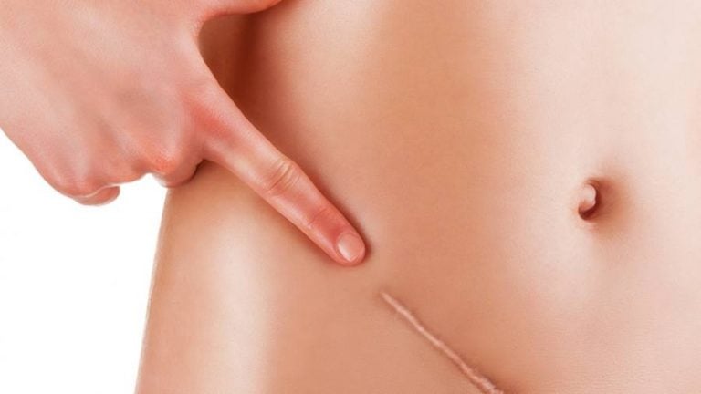 Crema e trattamento per le cicatrici