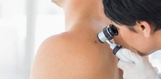 Il controllo dei nevi e la diagnosi precoce del melanoma controllo nei